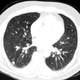 Illustration for article titled Radiologists fail miserably on the Invisible Gorilla Test when screening for cancer